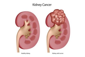 Kidney Cancer Symptoms, Diagnosis, Treatment & Recovery