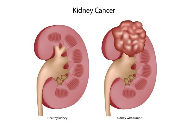 Kidney Cancer Symptoms, Diagnosis, Treatment & Recovery