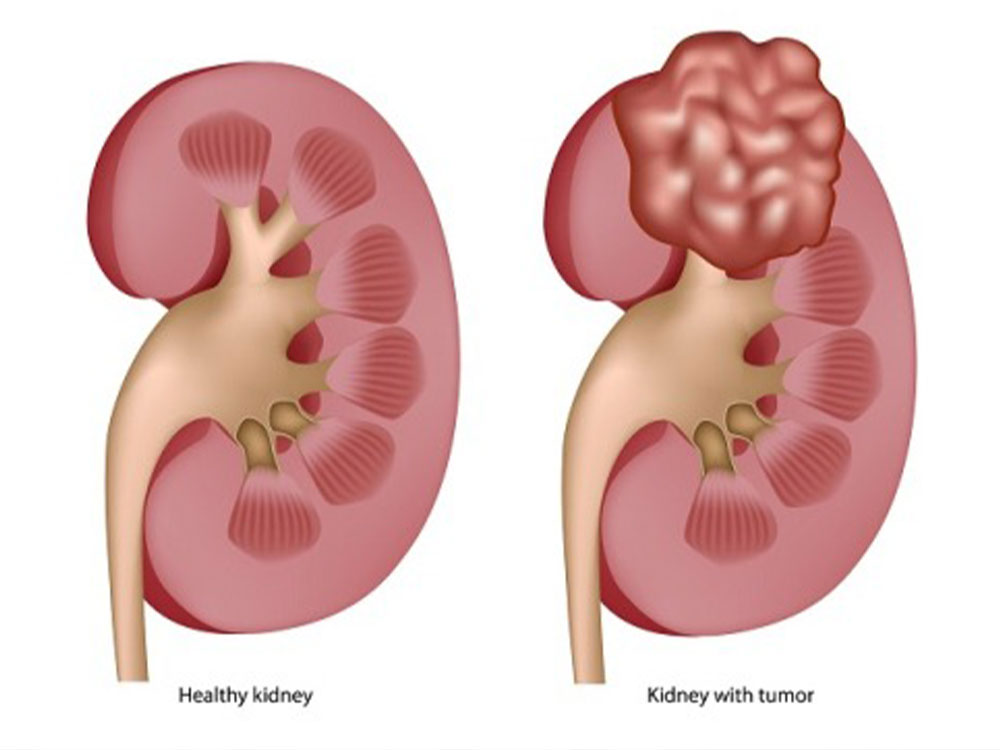 what-is-kidney-cancer-dr-yusuf-saifee