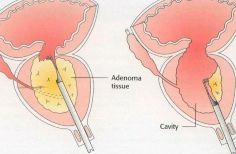 prostate enlargement treatment in indore