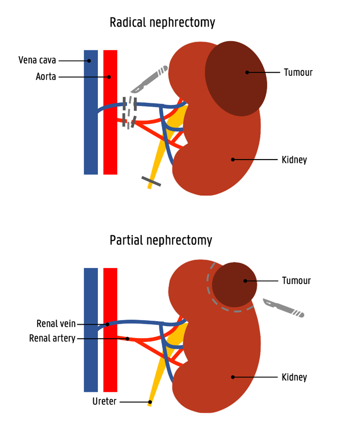 kidney cancer treatment in indore