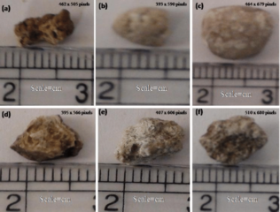 kidney stone surgery in indore