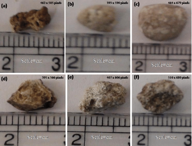 kidney stone surgery in indore
