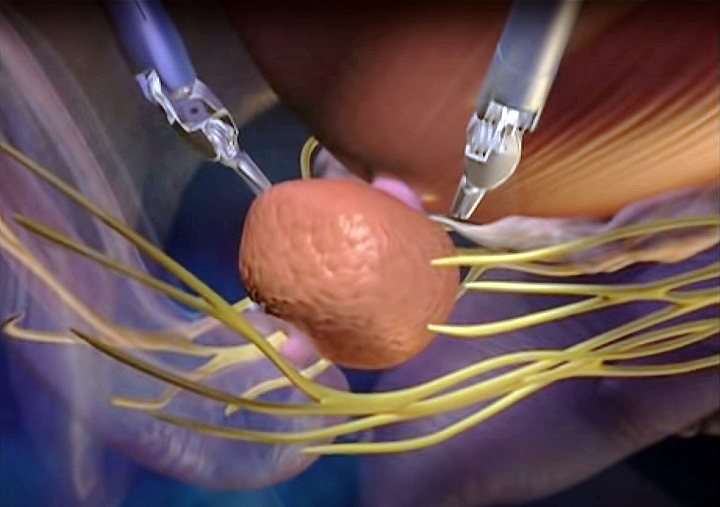 robotic prostate cancer surgery in indore