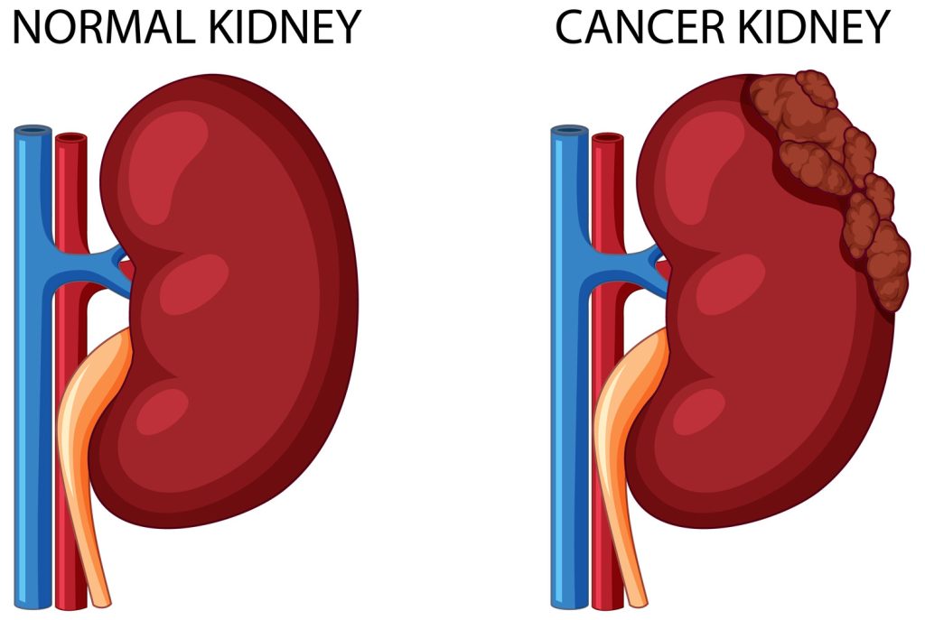 kidney cancer treatment