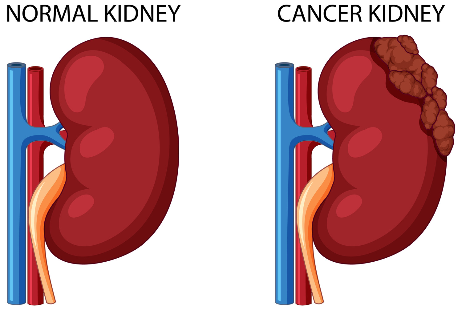 types-of-treatments-for-kidney-cancer-urologist