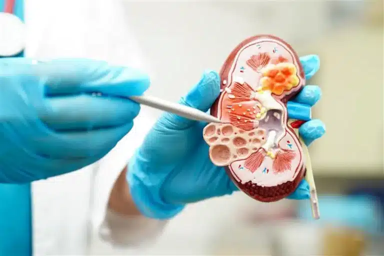 Laser Kidney stones surgery by Dr. Yusuf Saifee