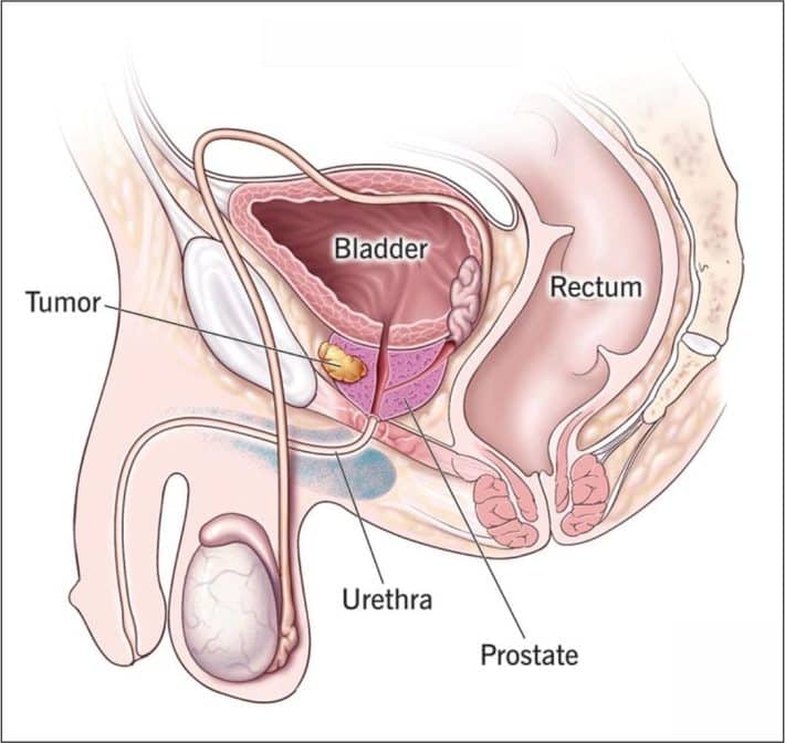 Diagram of how tumor is shown in Prostate Cancer