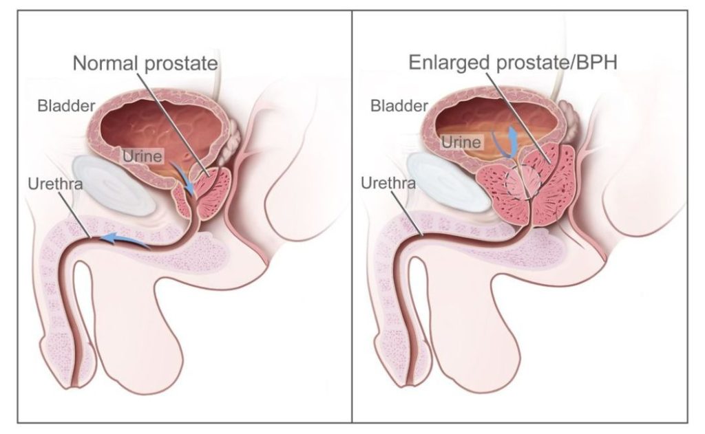Prostate Cancer Treatment in Mumbai
