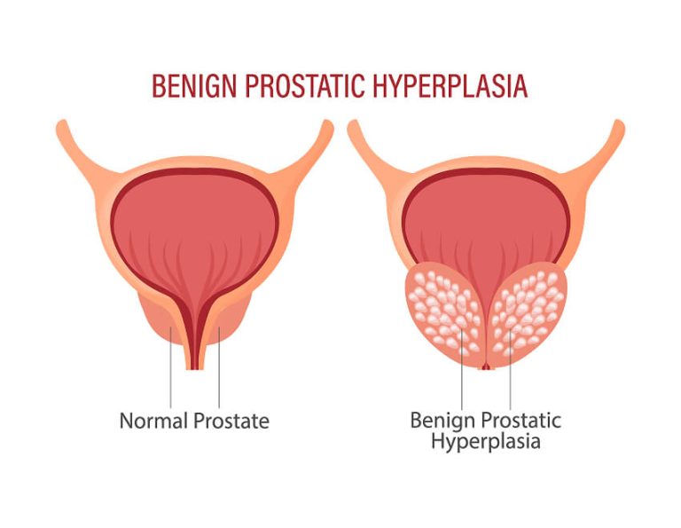 Normal prostate vs Benign prostatic hyperplasia