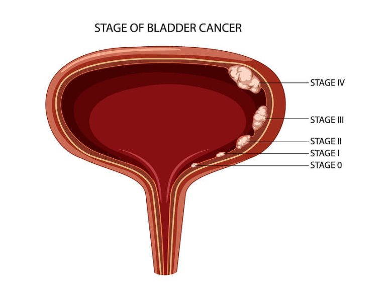 Bladder cancer and Stages of Bladder cancer - Dr. Yusuf Saifee