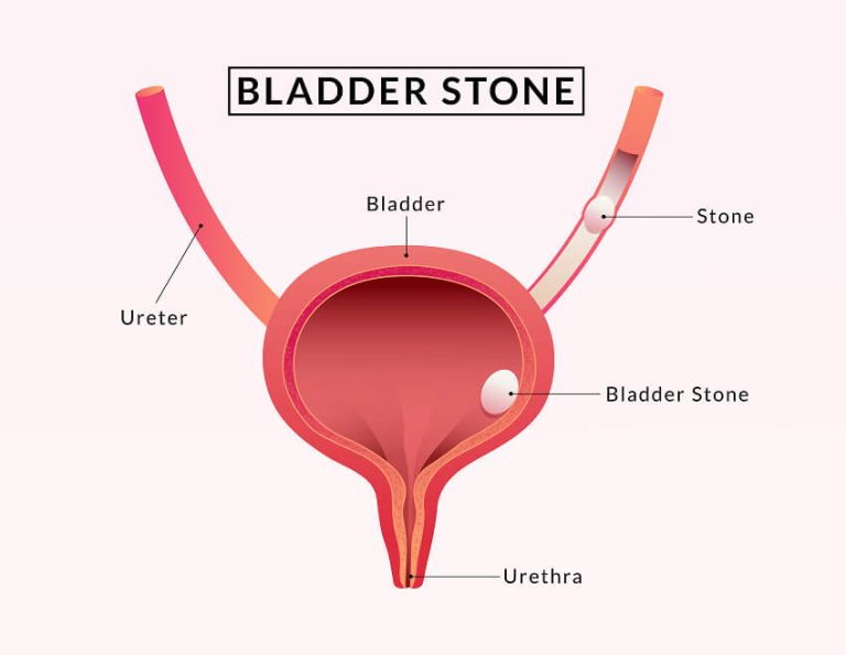 Bladder stones - Dr. Yusuf Saifee