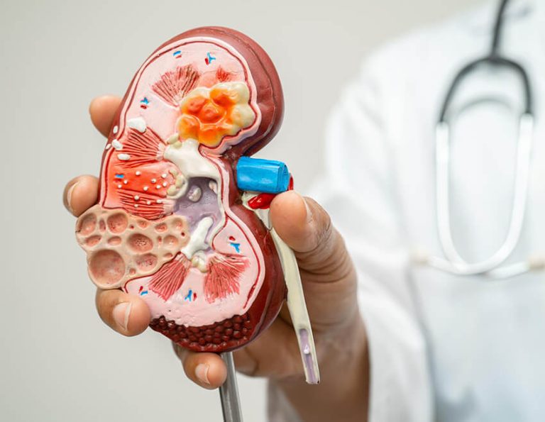 Kidney Cancer - Dr Yusuf Saifee Urologist