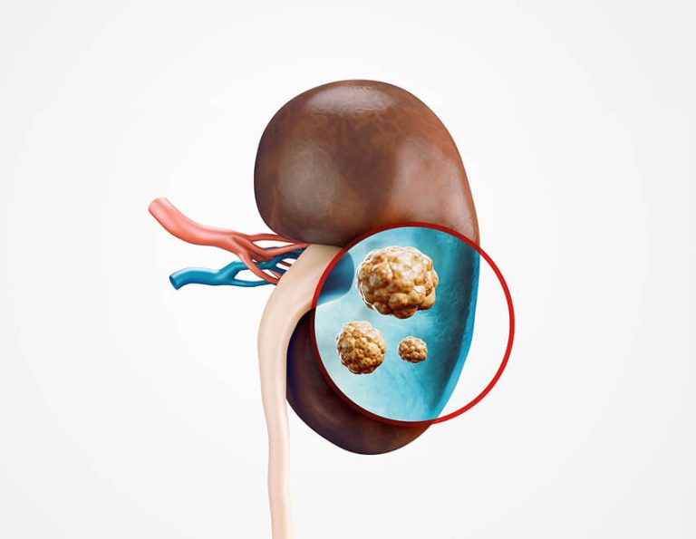 Kidney stones - Dr Yusuf Saifee Urologist