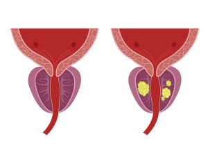 Normal prostate vs Prostate Cancer