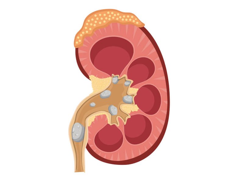 Uretric Stones - Dr. Yusuf Saifee