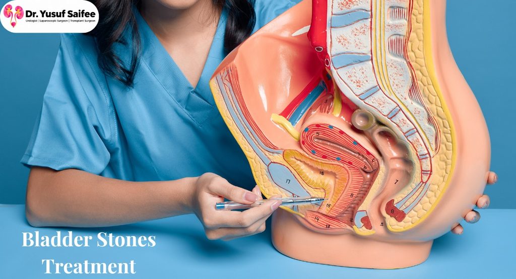 Bladder Stones: Dr Yusuf Saifee 