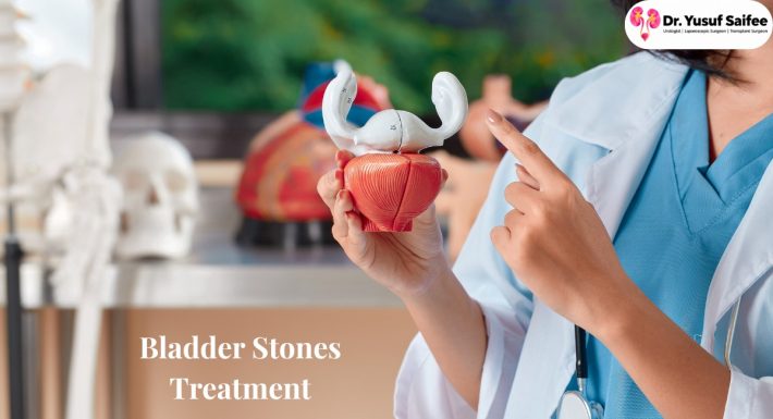Bladder Stones: Dr Yusuf Saifee