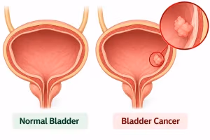 Normal bladder vs bladder cancer comparison showing healthy bladder and bladder with cancer tumor with magnified view of tumor cluster