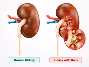 Normal kidney vs kidney with stone comparison diagram showing healthy kidney and kidney with multiple renal stones in calyces with magnified view
